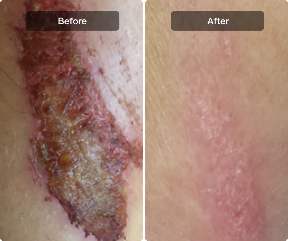 Accelerate Wound Healing in 5 Days.