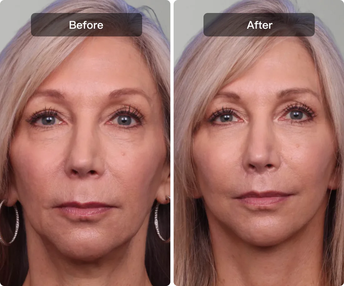 Lift and Firm for Anti-Sagging in 4 Weeks.