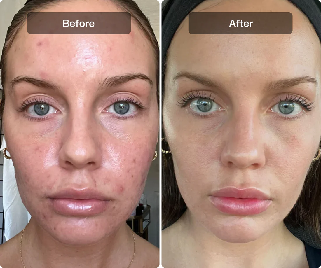Support for blemish-prone skin areas